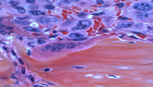 Cancer pic 1